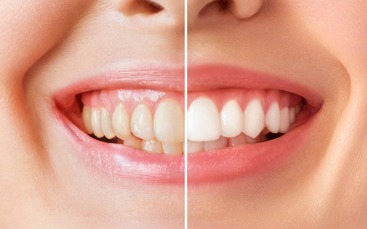 ホワイトニング 以外 で 歯 を 白く する 方法